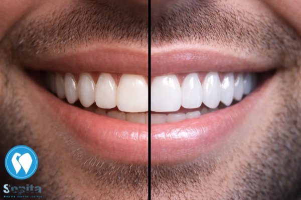 تفاوت های لمینت سرامیکی و کامپوزیت