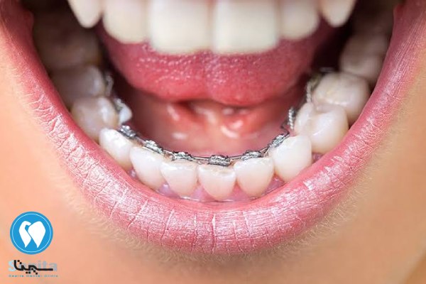 ارتودنسی نامرئی لینگوال