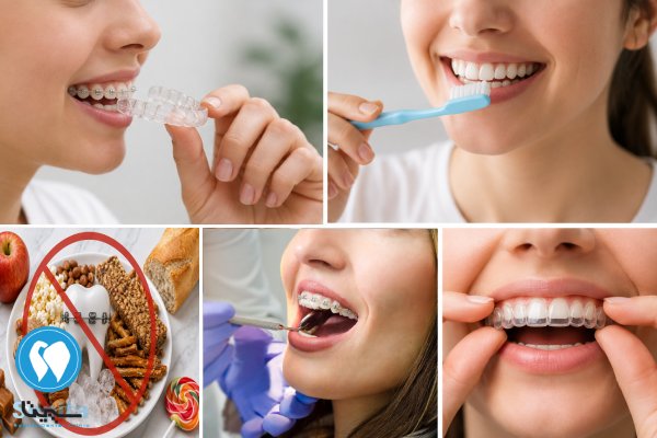 مراقبت های بعد از ارتودنسی دندان خرگوشی