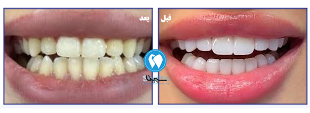 لمینت دندان خرگوشی در تهرانسر