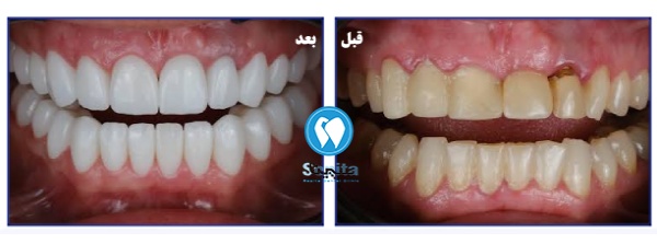 نمونه واقعی قبل و بعد کامپوزیت دندان توسط دکتر متخصص کامپوزیت