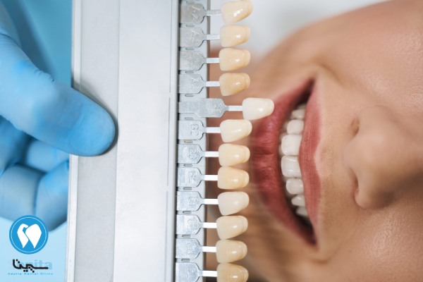 اصلاح طرح لبخند توسط دکتر متخصص کامپوزیت
