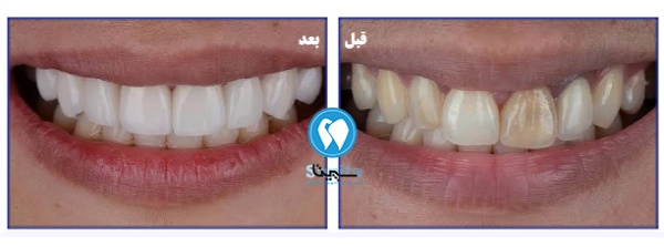 مراحل انجام لمینت دندان؛ تغییرات قبل و بعد درمان
