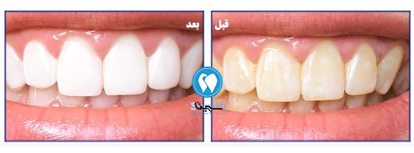 قیمت بلیچینگ دندان در تهرانسر به همراه نمونه قبل و بعد 