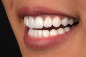 بهترین سن برای لمینت دندان
