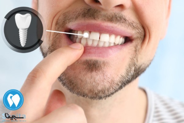 بعد از ایمپلنت چه مراقبت هایی لازم است؟