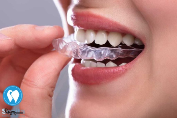 مزایای هوم بلیچینگ نسبت به آفیس بلیچینگ