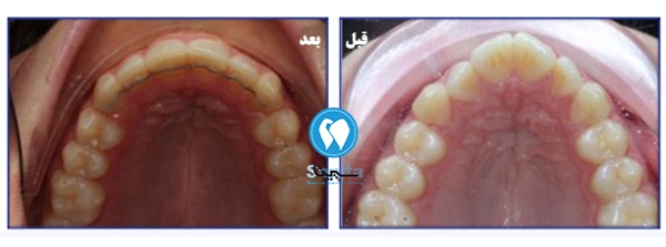 قبل و بعد ارتودنسی لینگوال و مدت زمان درمان