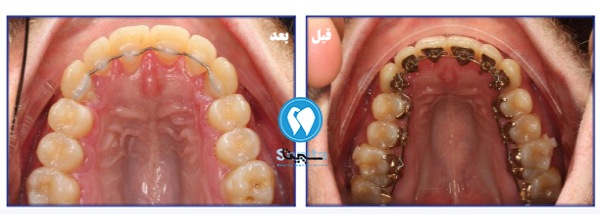 قبل و بعد ارتودنسی لینگوال در کلینیک سپیتا 