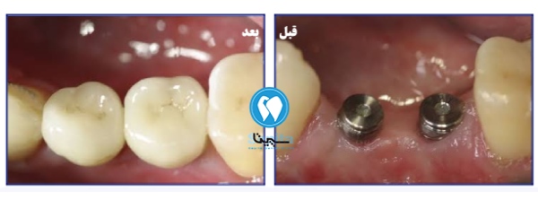 قبل و بعد ایمپلنت چند دندان کنار هم