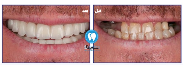 مقایسه قبل و بعد؛ تأثیر پروتز ثابت دندان 