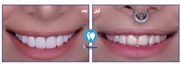 قبل و بعد کامپوزیت دندان