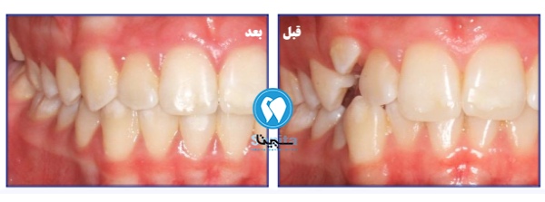 قبل و بعد درمان ارتودنسی دندان نیش کج