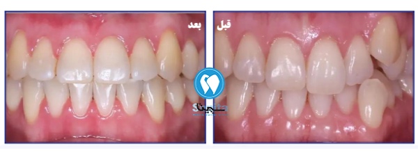 ارتودنسی دندان نیش؛ قبل و بعد از درمان