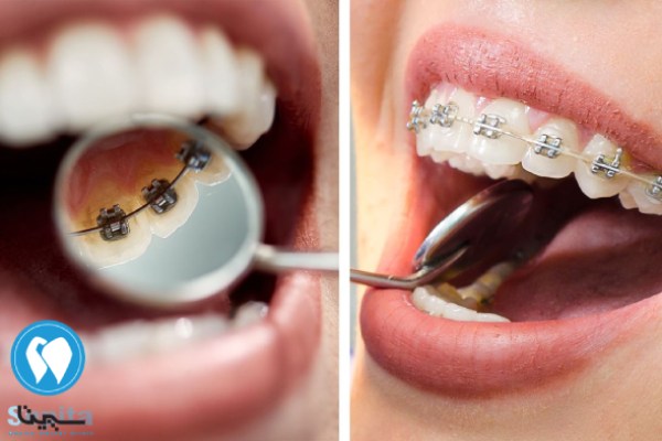 تفاوت ارتودنسی لینگوال و ارتودنسی معمولی