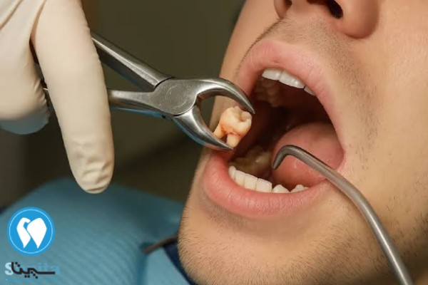 چه زمانی به جراحی دندان نیاز داریم؟
