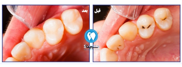 قبل و بعد درمان ترمیم دندان کودکان