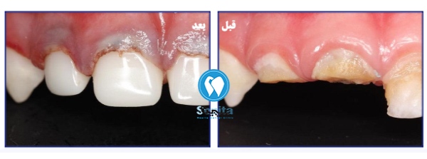 نمونه قبل و بعد روکش دندان شیری کودکان پس از آسیب‌ دیدگی 