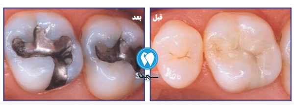 قبل و بعد پرکردن دندان شیری