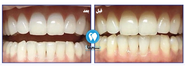 قبل و بعد از آفیس بلیچینگ دندان