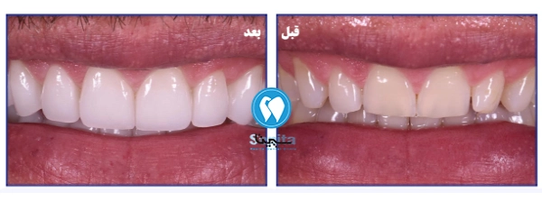 قبل و بعد لمینت بدون تراش 
