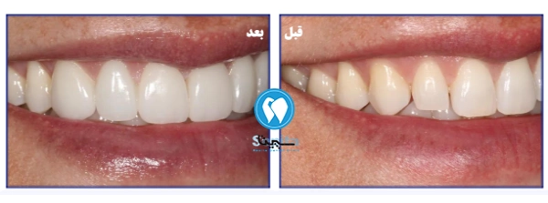 قبل و بعد لمینت بدون تراش دندان در تهرانسر 