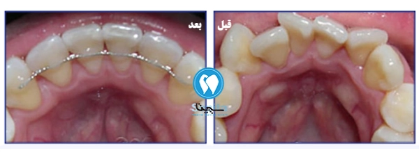 قبل و بعد ارتودنسی دندان جلو