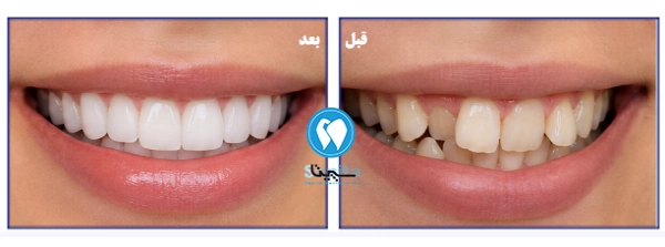 تصاویر قبل و بعد لمینت دندان کج در تهرانسر