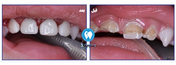 قبل و بعد ترمیم دندان شکسته کودکان